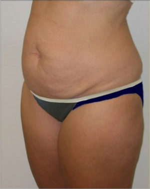 Abdominoplasty Before and After Photos