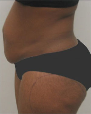 Abdominoplasty Before and After Photos