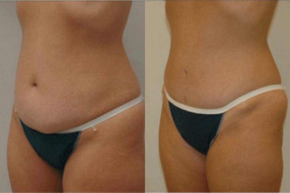 35 year old before and after tummy tuck front view