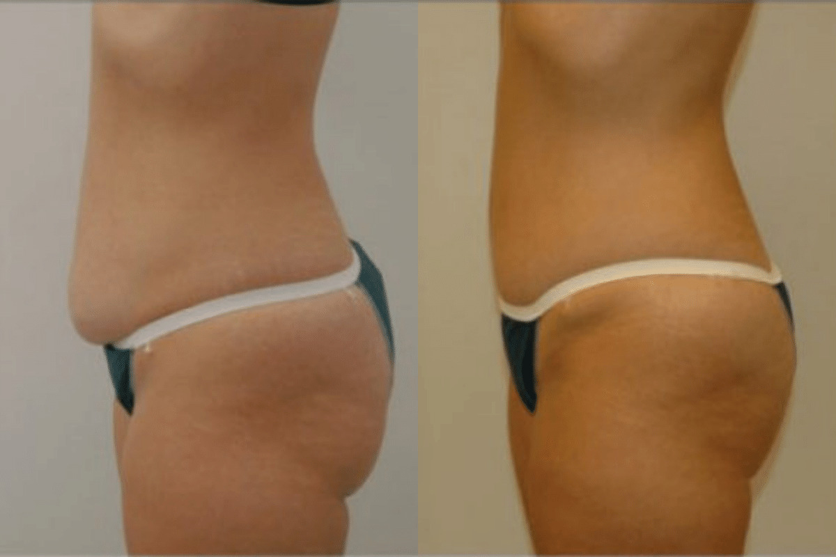 35 year old before and after tummy tuck side view
