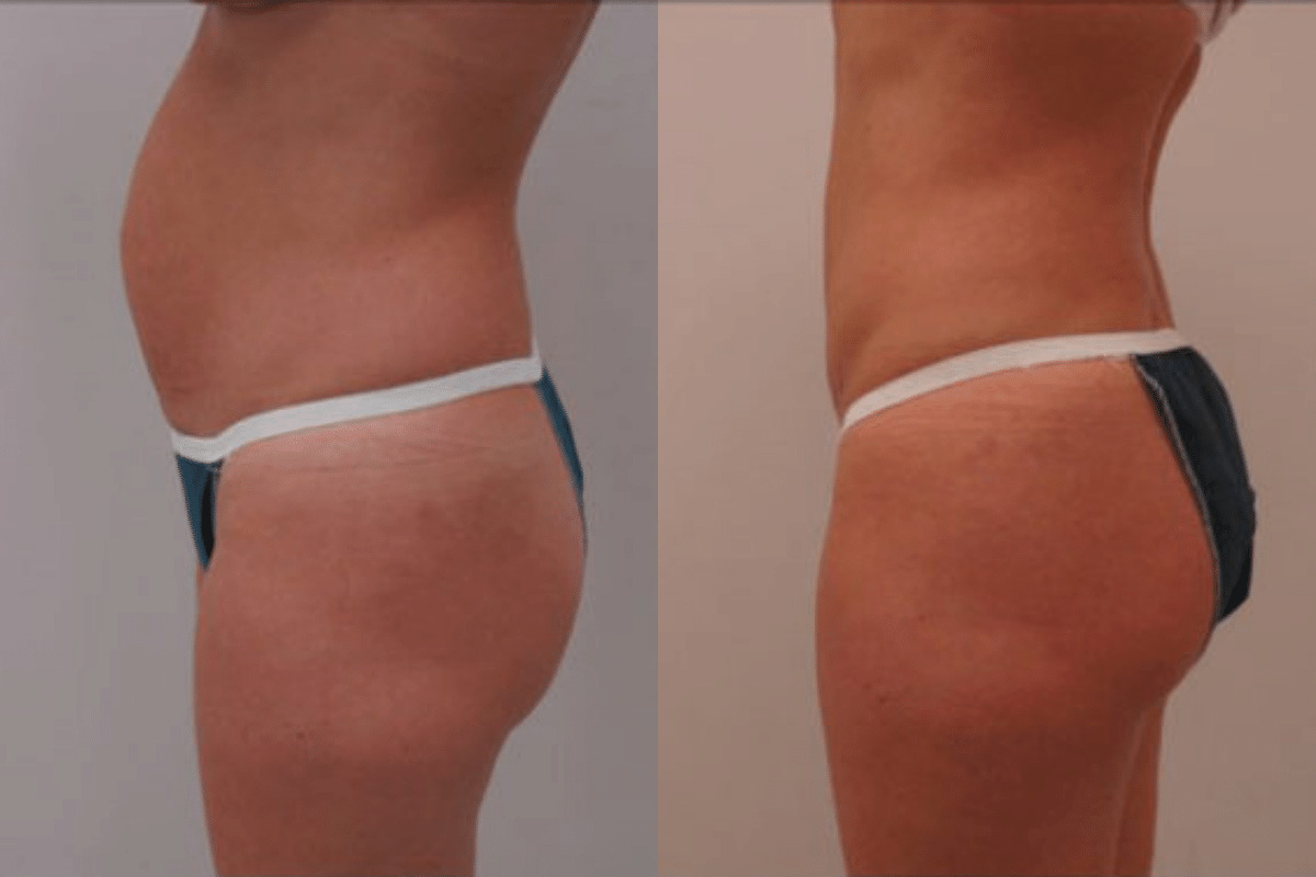 35 year old female before and after tummy tuck side view