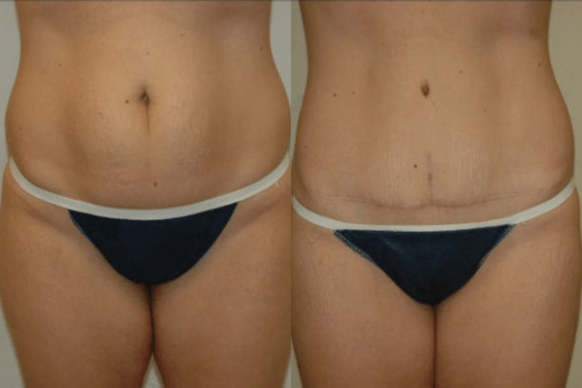 28 year old female before and after tummy tuck front view