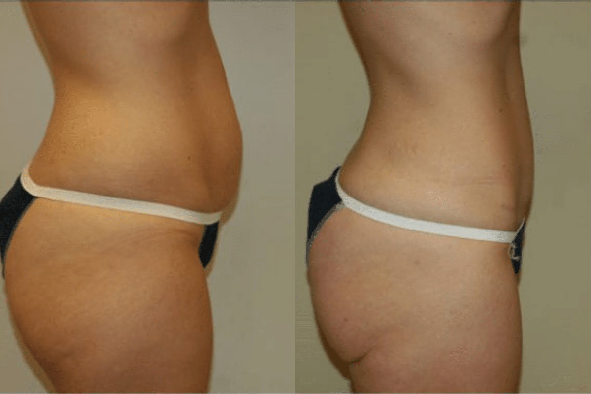 28 year old female before and after tummy tuck side view