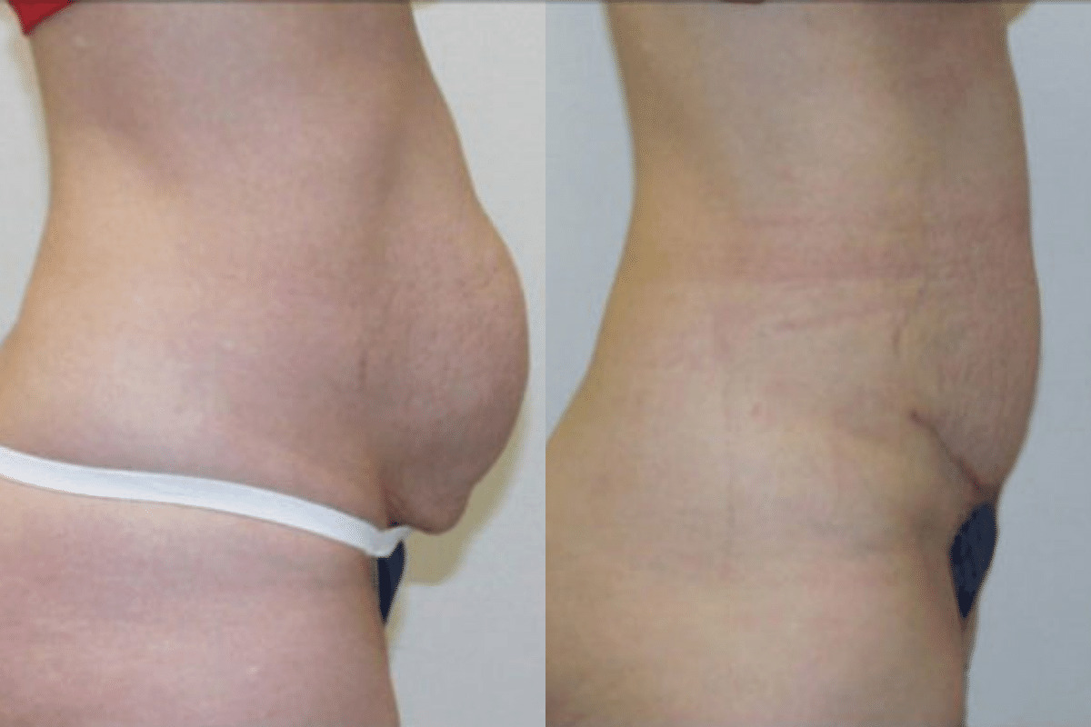 25 year old female before and after tummy tuck side view