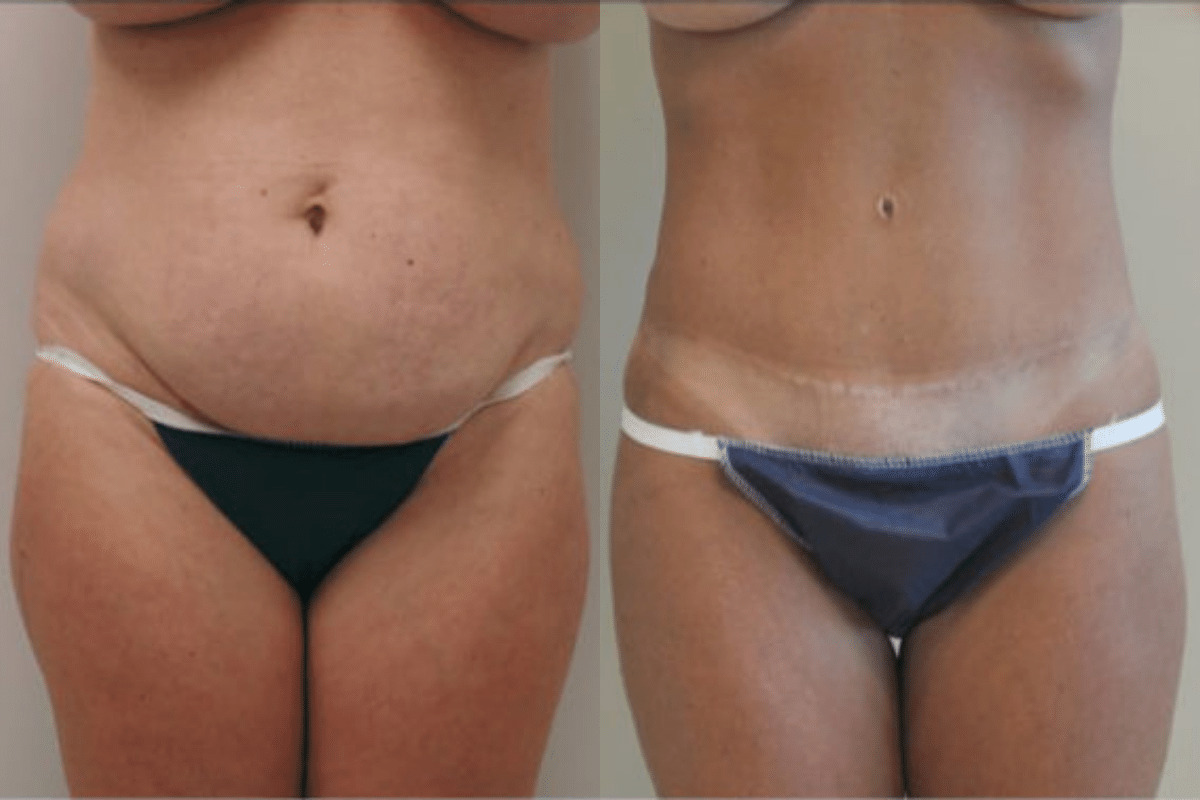 Mini Tummy Tuck (Mini Abdominoplasty) in Atlanta, Georgia