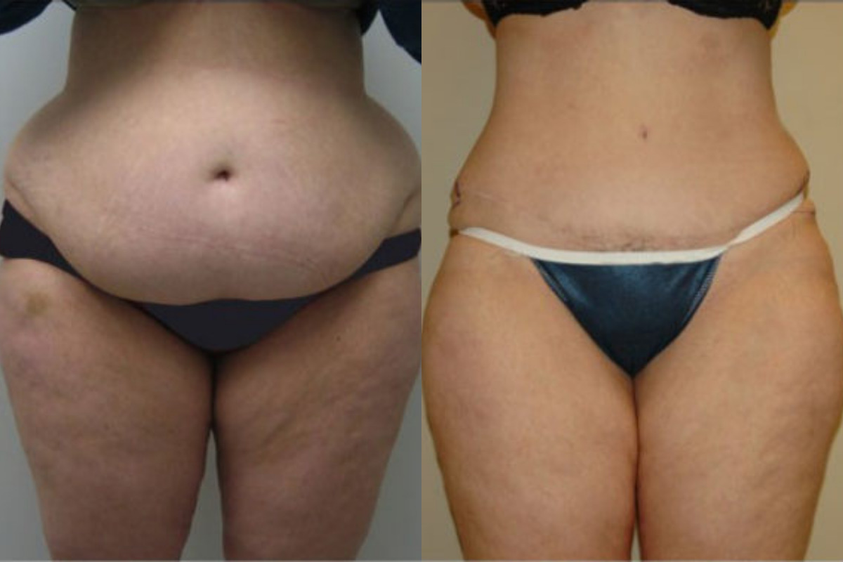 Mini Tummy Tuck (Mini Abdominoplasty) in Atlanta, Georgia