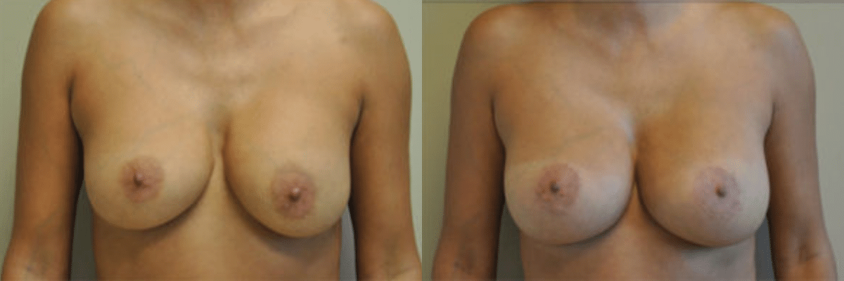 37 year old before and after breast asymmetry and augmentation surgery front view