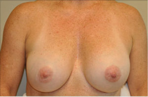 Breast Revision Before and After Photos