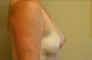Breast Revision Before and After Photos