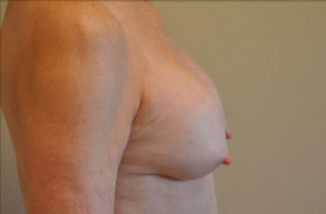 Breast Capsular Contracture Before and After Photos