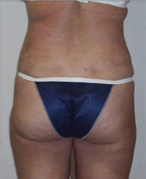 Liposuction Before and After Photos