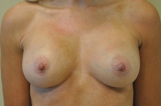Liposuction Before and After Photos