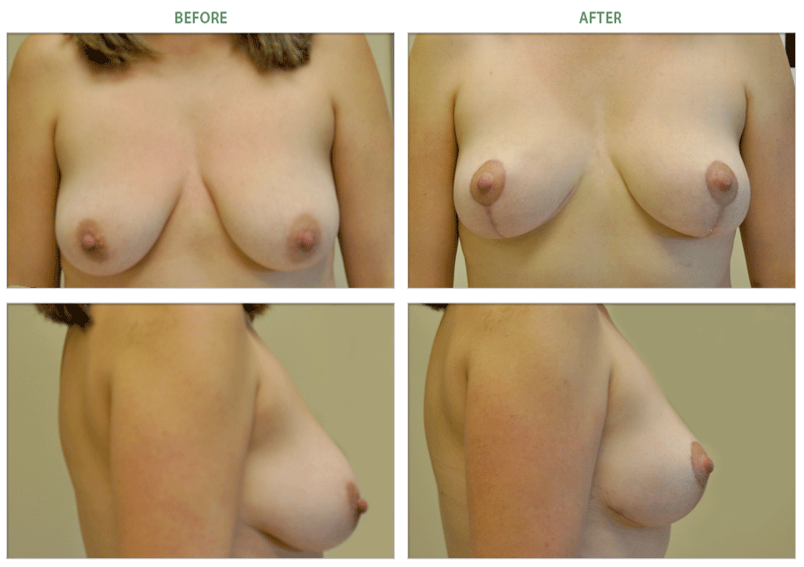 breast lift surgery before and after photo