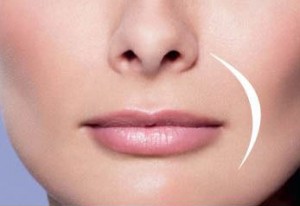 Juvederm Smile Lines