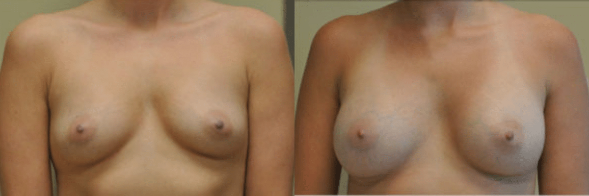 28 year old female before and after 304cc saline implant breast augmentation front view