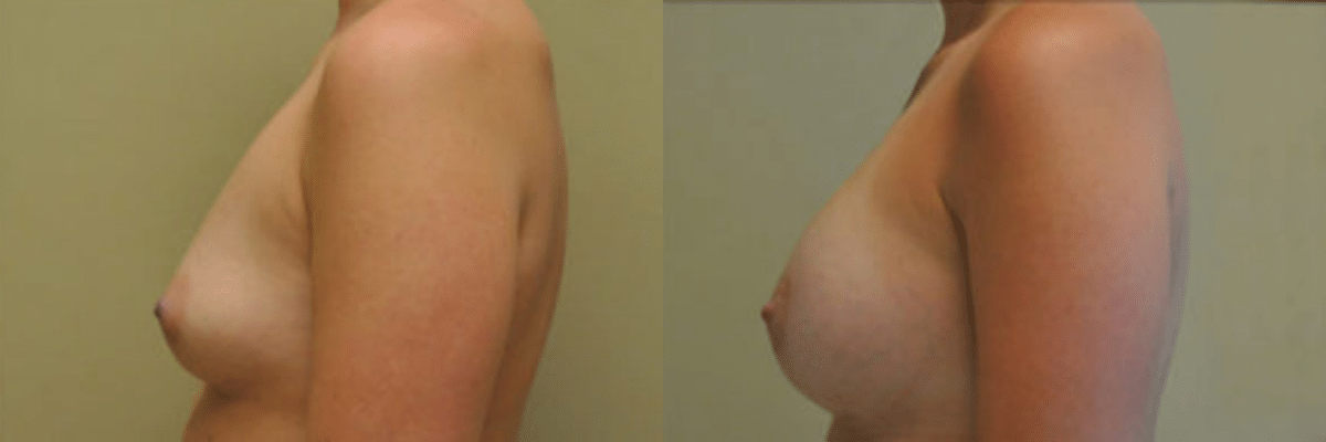 28 year old female before and after 304cc saline implant breast augmentation side view