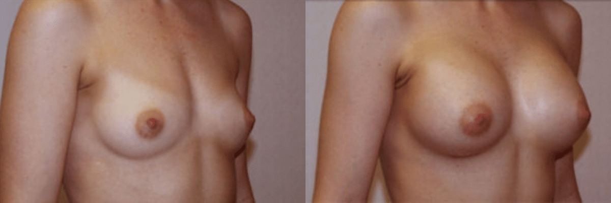 30 year old female before and after saline implant breast augmentation front view