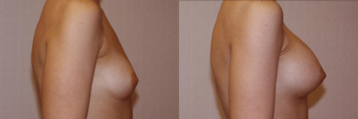 30 year old female before and after saline implant breast augmentation side view