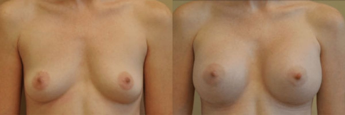34 year old female before and after 339cc gel implant breast augmentation front view