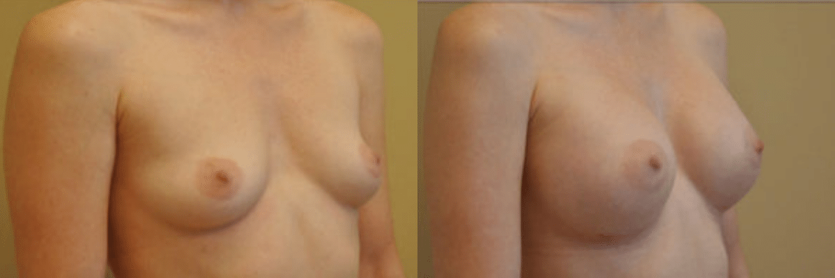 34 year old female before and after 339cc gel implant breast augmentation side view