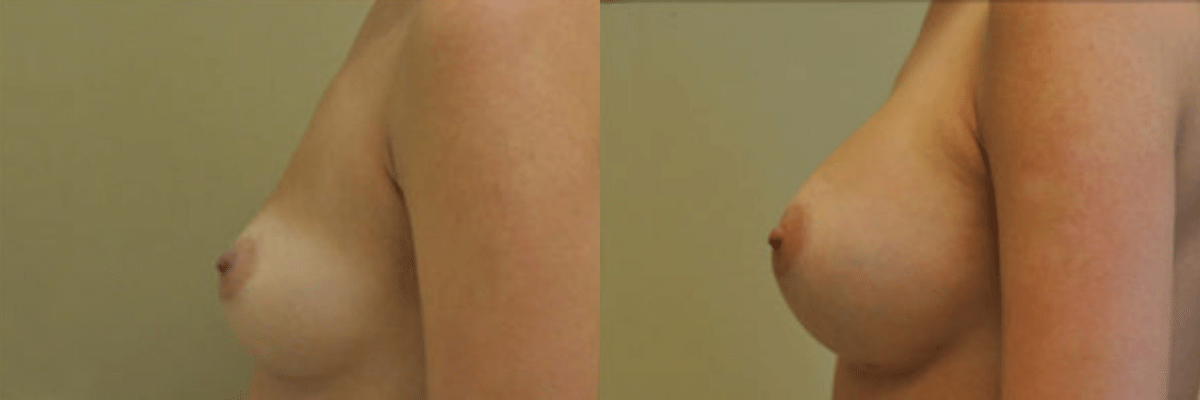30 year old female before and after 339cc gel implant breast augmentation side view