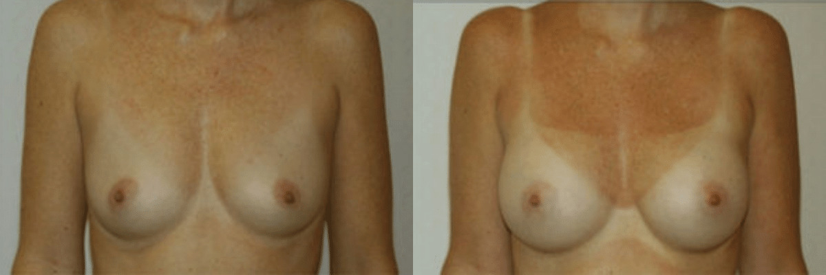 40 year old female before and after 270cc saline implant breast augmentation front view