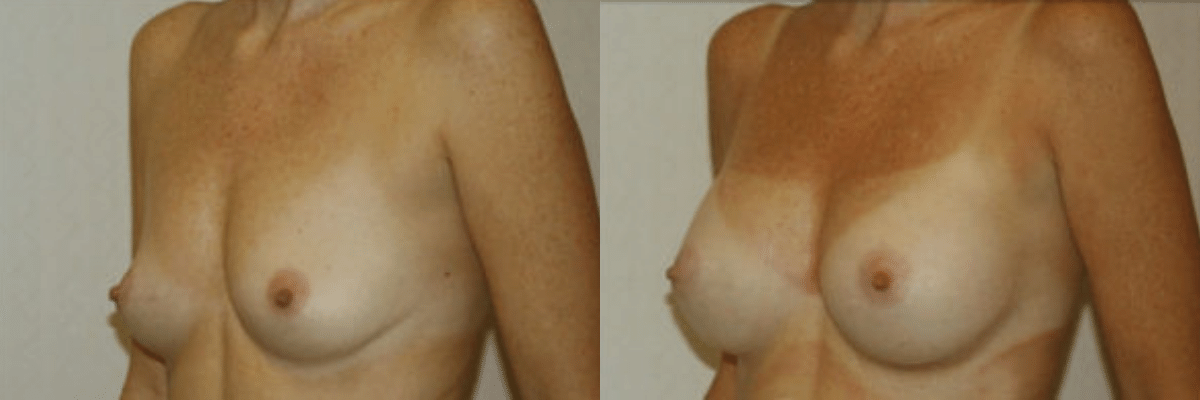 40 year old female before and after 270cc saline implant breast augmentation side view