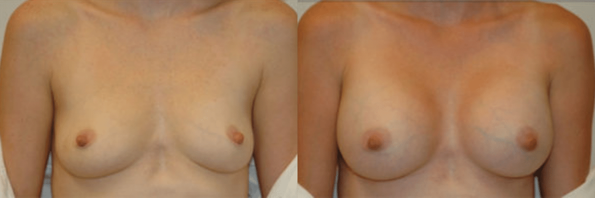 30 year old female before and after breast augmentation front view