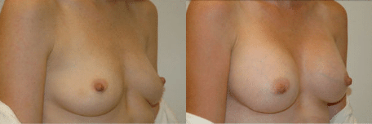 30 year old female before and after breast augmentation side view