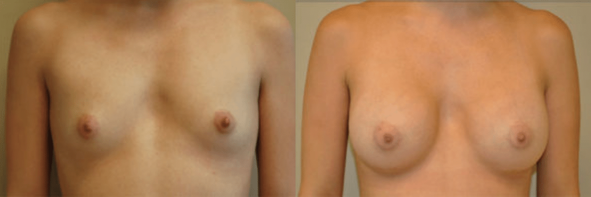 27 year old female before and after 339cc gel implant breast augmentation front view