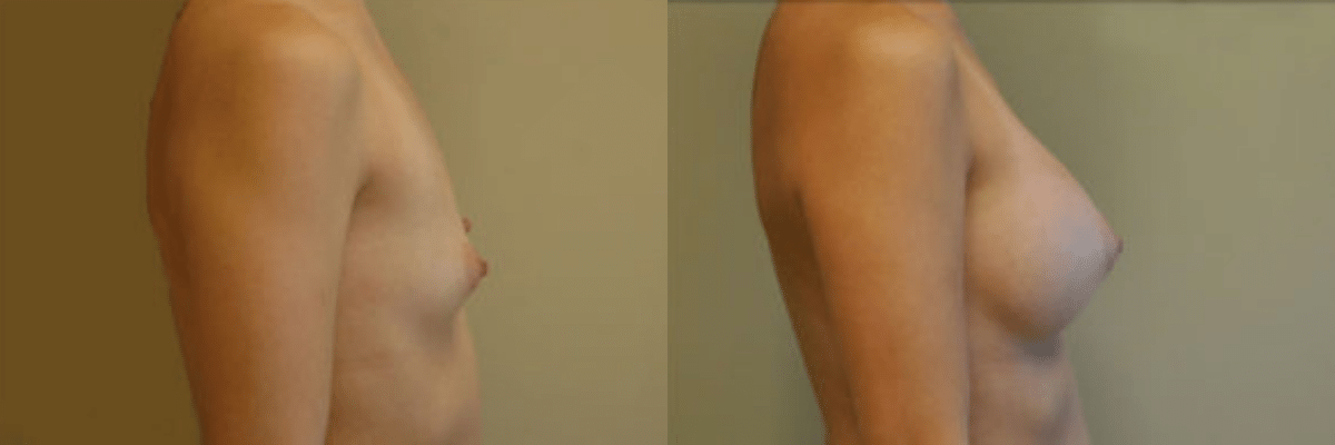 27 year old female before and after 339cc gel implant breast augmentation side view