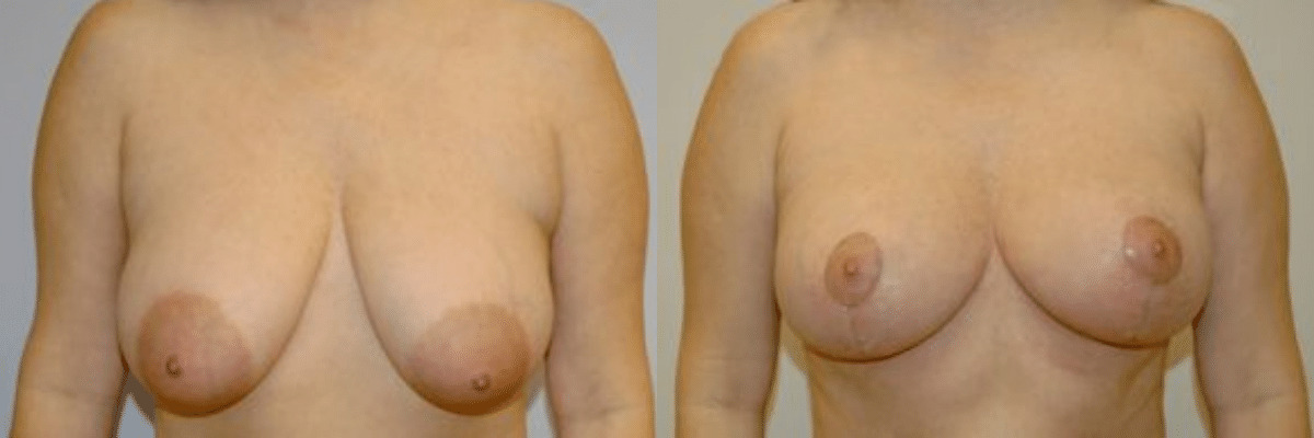 40 year old female breast lift before and after front view