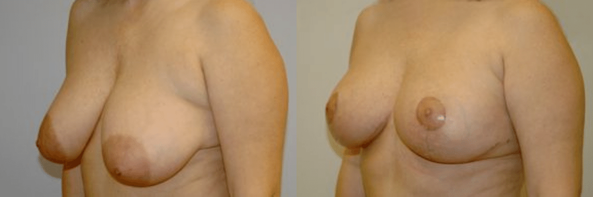 40 year old female breast lift before and after side view