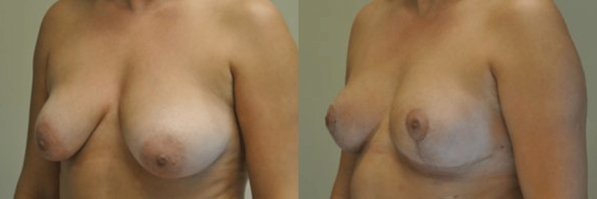39 year old female patient before and after breast lift front view