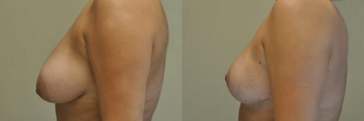 39 year old female patient before and after breast lift side view