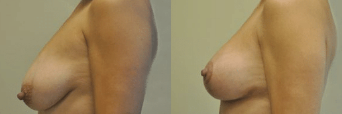 47 year old female before and after breast lift side view