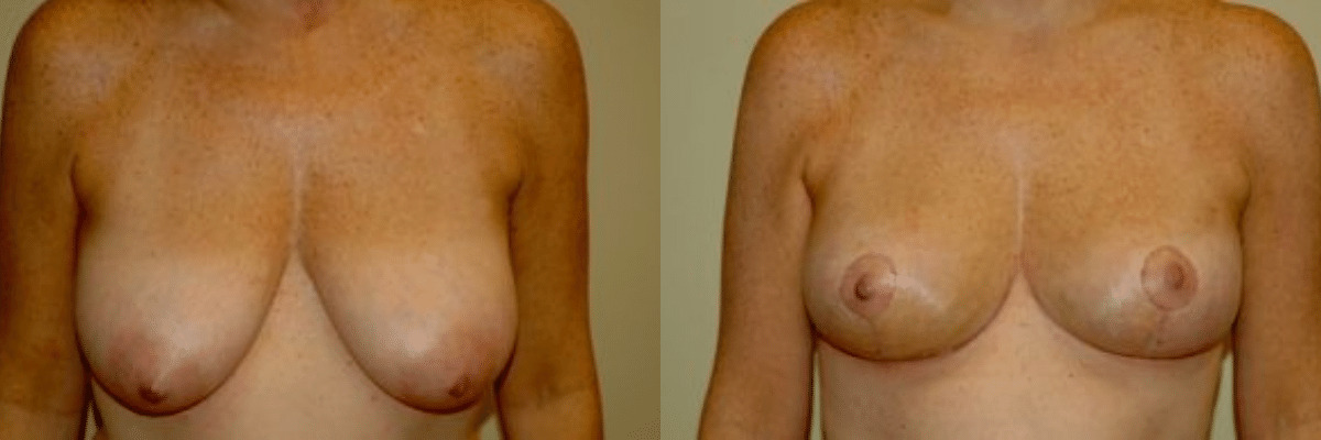 51 year old female 1 week post op before and after breast lift front view