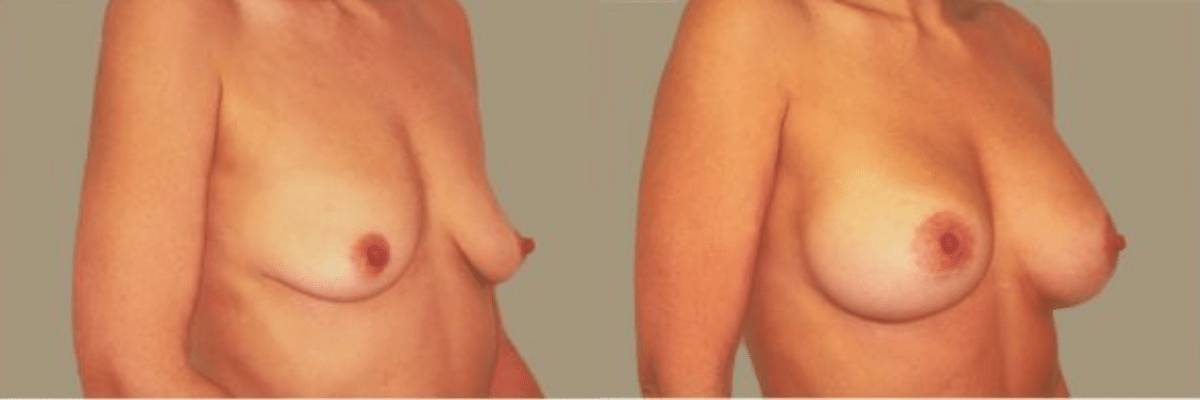 27 year old female before and after breast lift and augmentation front view