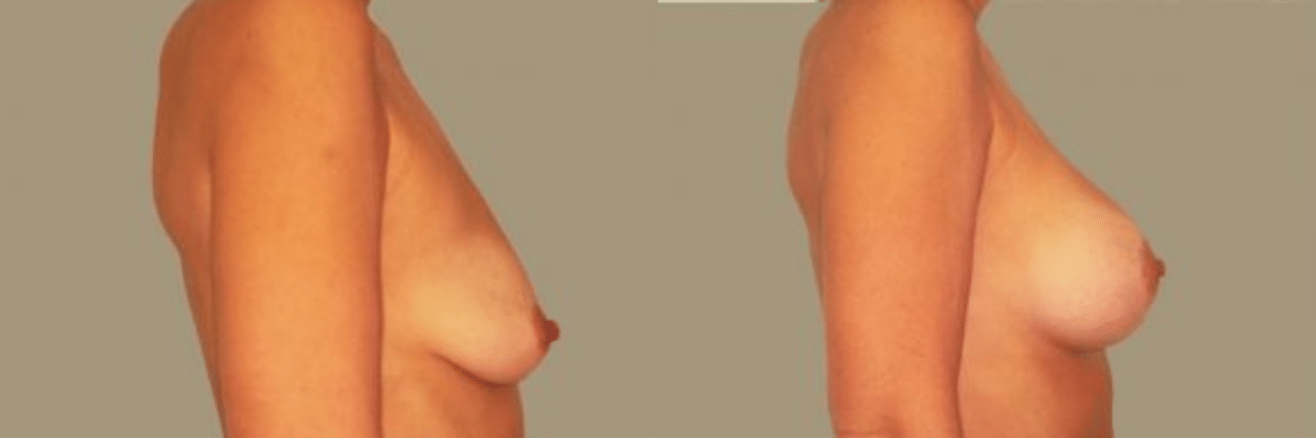 27 year old female before and after breast lift and augmentation side view