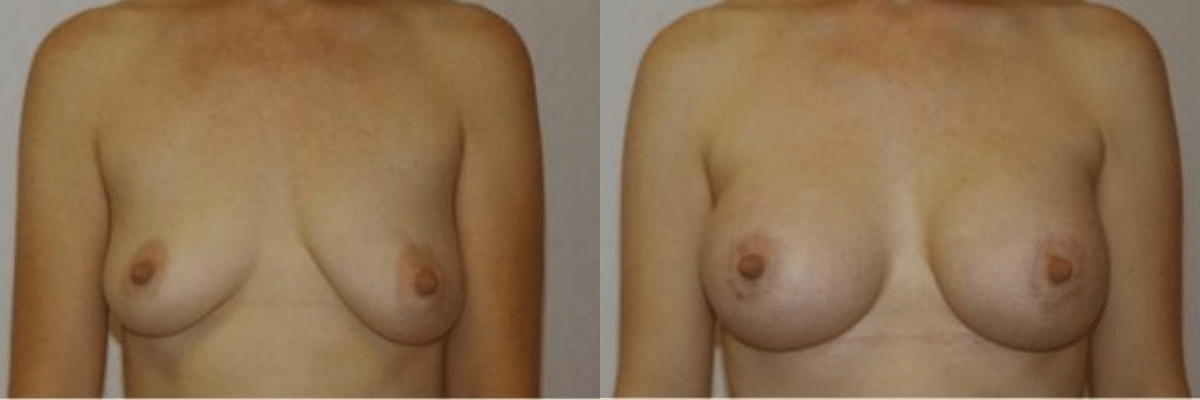 30 year old female breast lift and augmentation before and after front view