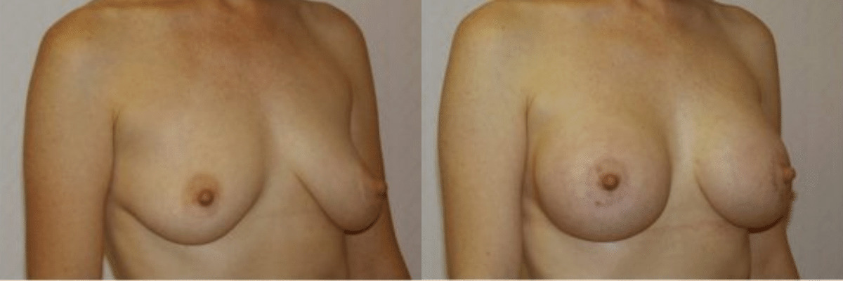 30 year old female breast lift and augmentation before and after side view