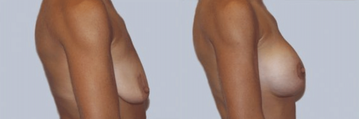 35 year old female before and after breast lift and augmentation side view