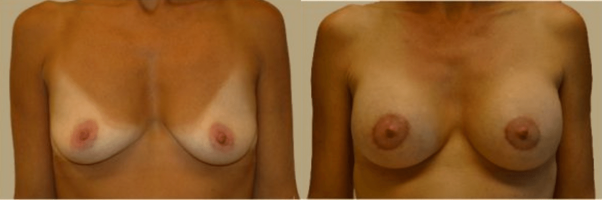 40 year old female before and after breast lift and augmentation front view