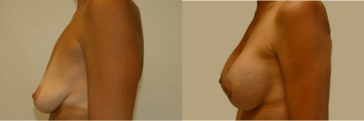 40 year old female before and after breast lift and augmentation side view