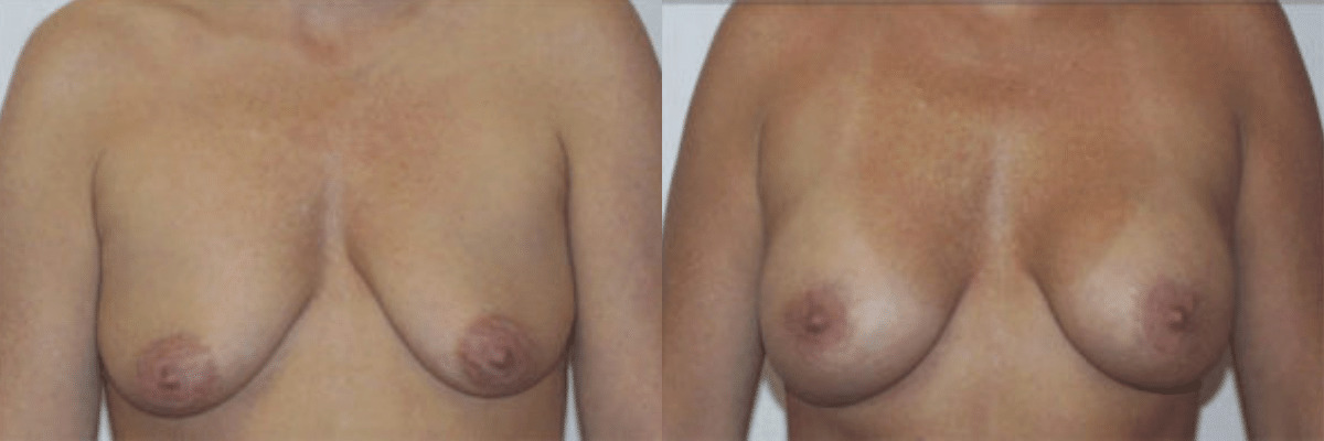 female before and after breast lift and augmentation front view
