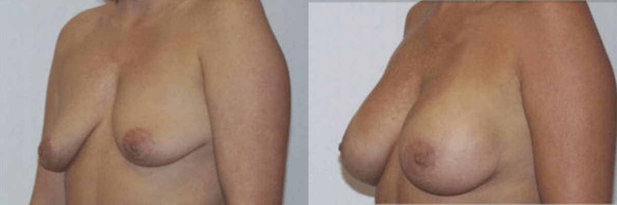 female before and after breast lift and augmentation side view
