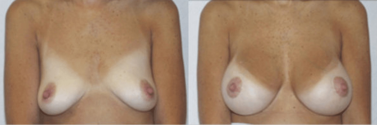 51 year old female before and after breast lift and augmentation front view