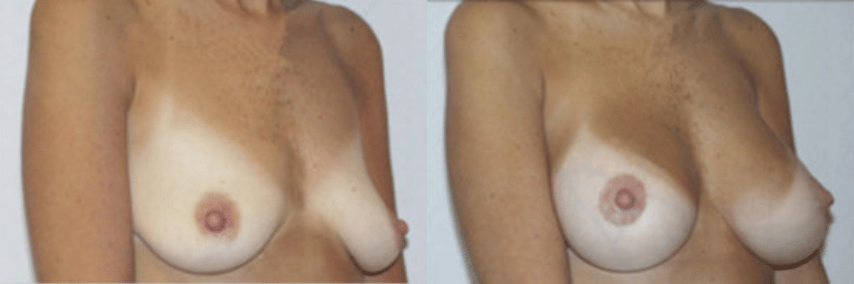 51 year old female before and after breast lift and augmentation side view