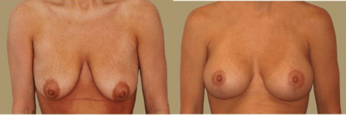 28 year old female before and after breast lift and augmentation front view