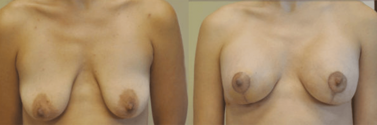 32 year old female before and after breast lift and augmentation silicone gel implant front view